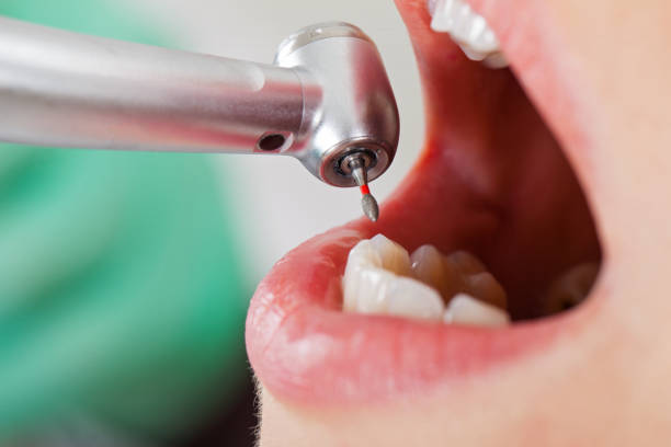 Best Emergency Wisdom Teeth Removal in Bossier City, LA